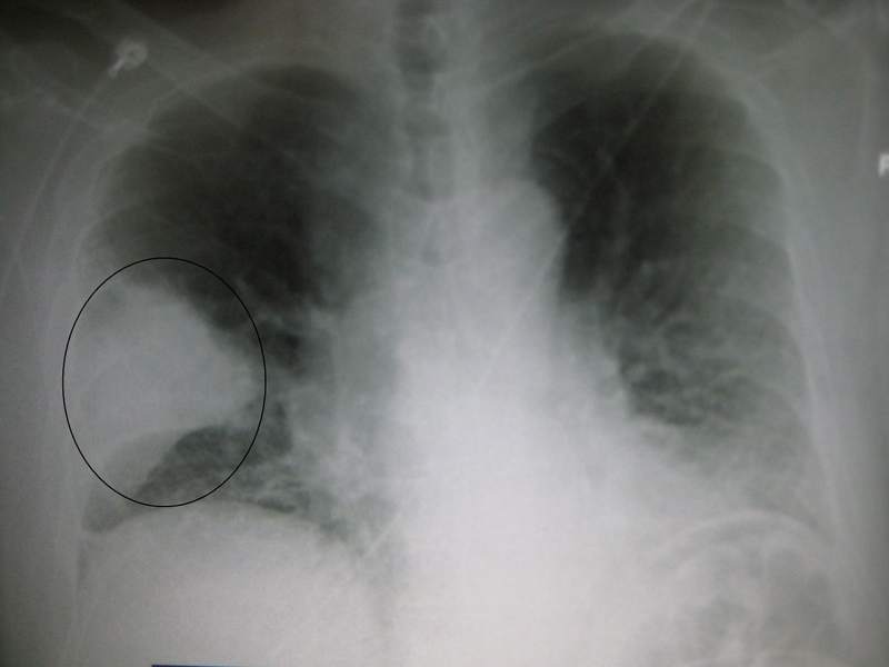 ostre zapalenie płuc wywołane pneumokokami